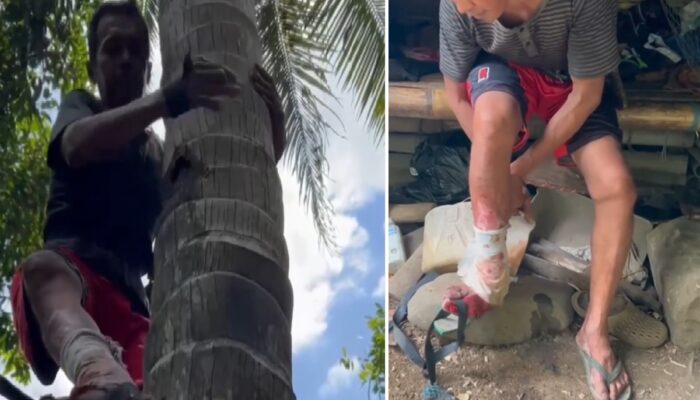 Kisah Pilu Nana, Buruh Nira Yang Gigih Bekerja Walau Kaki Membusuk dan Tinggal di Gubuk Tanpa Listrik